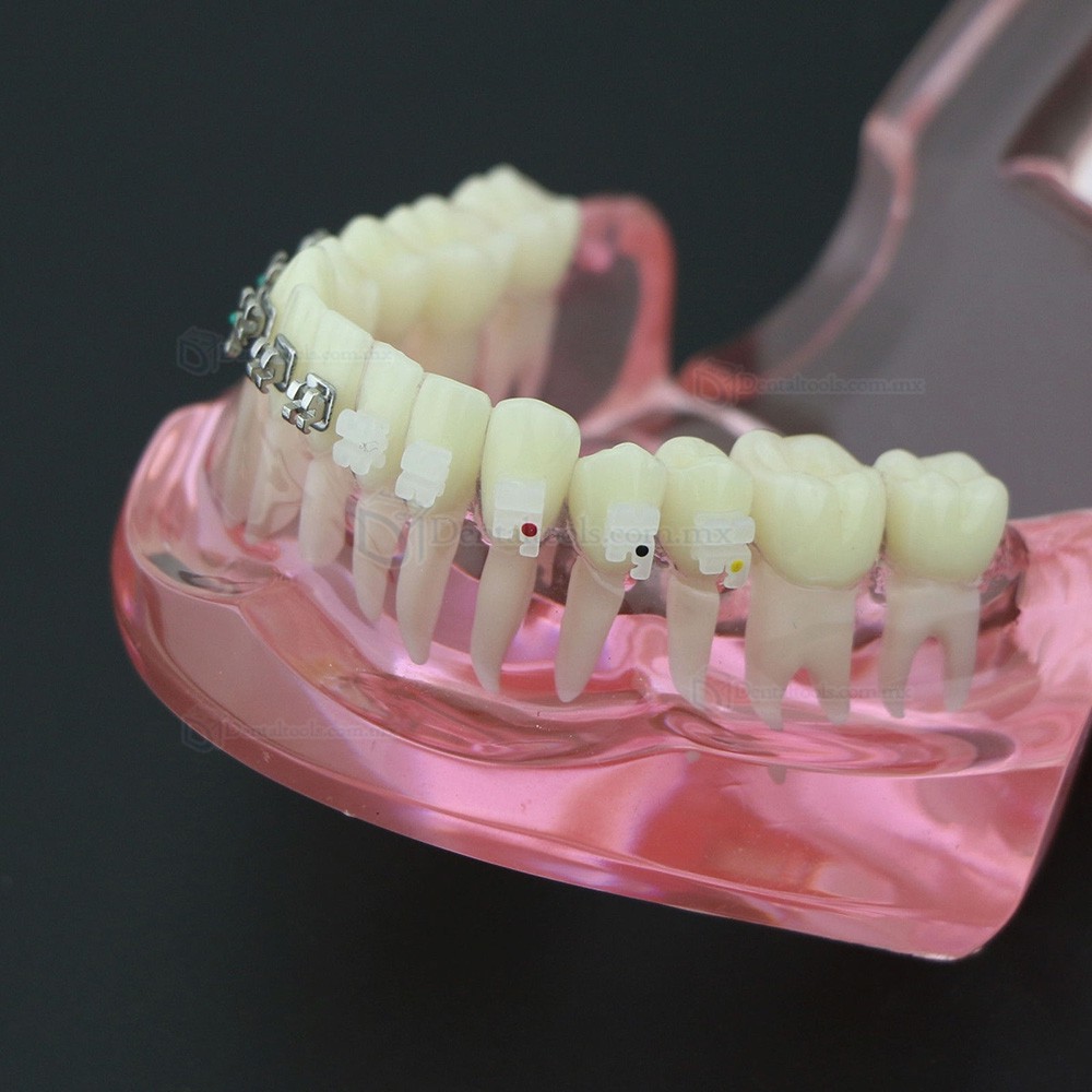 Modelo de ortodoncia con brackets metálicos y cerámicos para enseñanza 3003 Modelo de ortodoncia con brackets metálicos y cerámicos para enseñanza 3003