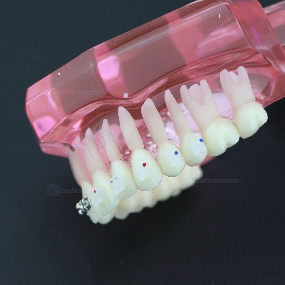 Modelo de ortodoncia con brackets metálicos y cerámicos para enseñanza 3003 Modelo de ortodoncia con brackets metálicos y cerámicos para enseñanza 3003