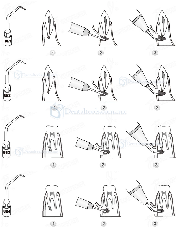 4pcs Woodpecker® PIEZO SURGERY Dental Endodontic Consejos Kit UE1 UE2 UE3 UE4 Para EMS